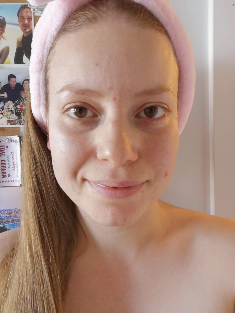 minha pele em 2018, após tratamento com roacutan